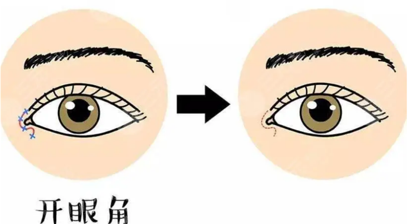 青岛开眼角图片