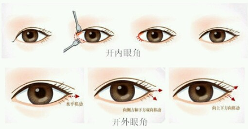  青岛开眼角图片
