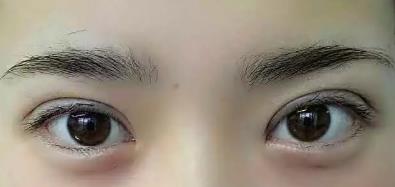 双眼皮
