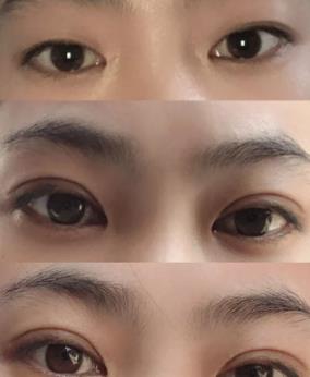 双眼皮