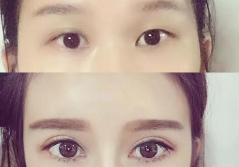 开眼角